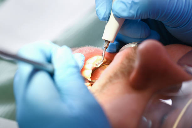 Best Emergency Treatment for Oral Infections in Oshkosh, WI